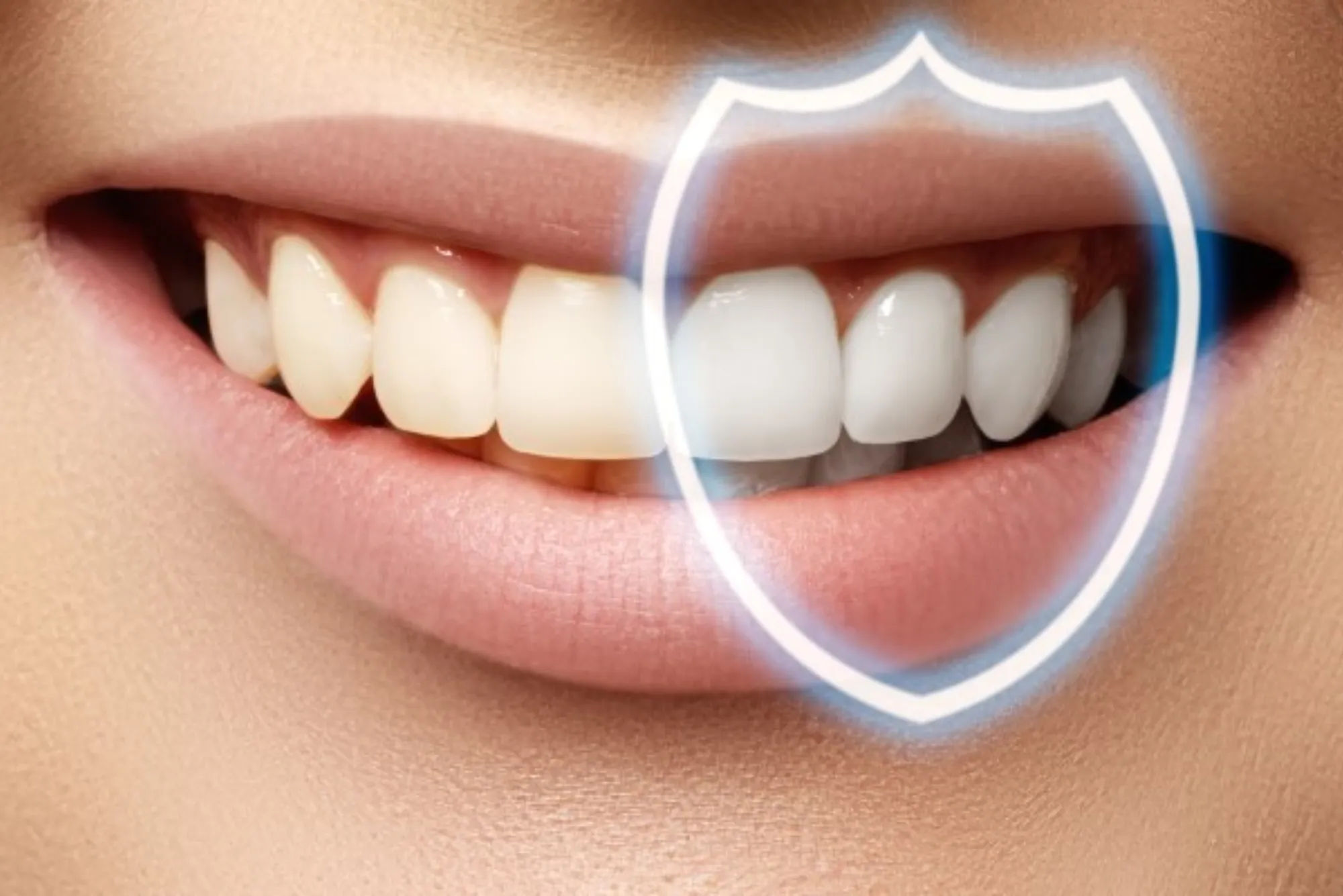 How does Zoom teeth whitening work