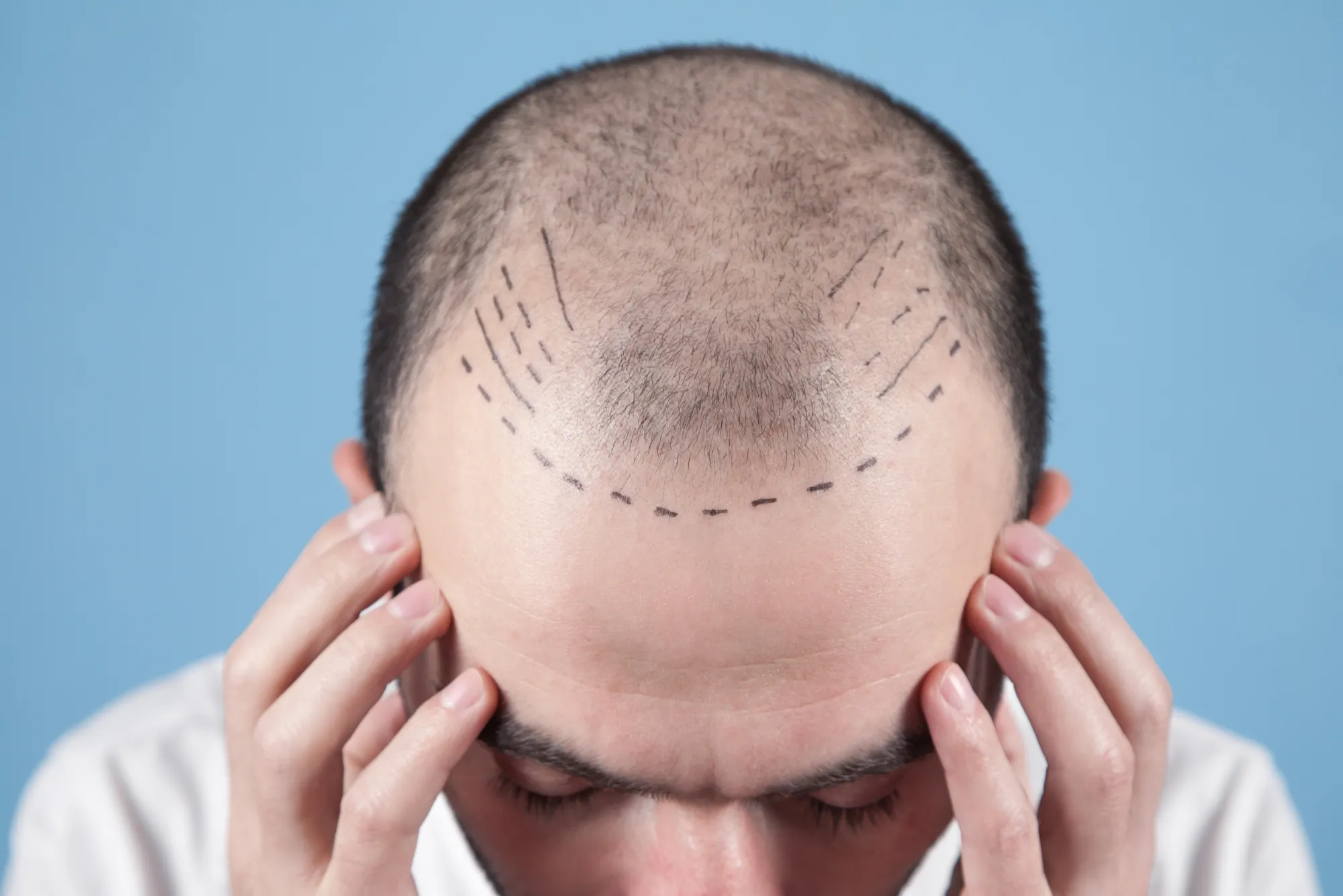 هل زراعة الشعر في دبي هي الخيار الأنسب لك؟